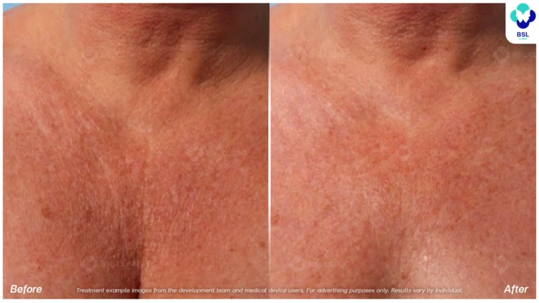 Before After result ulthera Chest