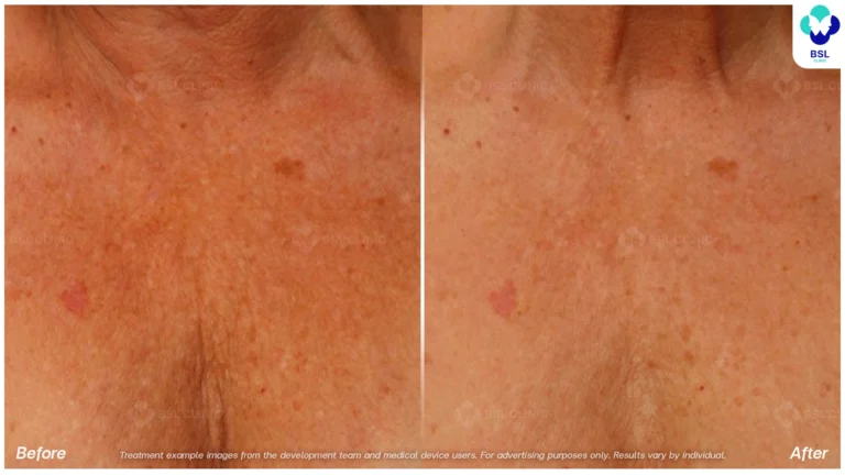 Before After result ulthera Chest