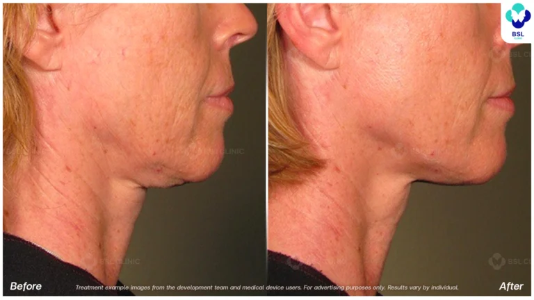 Before After result ultraterapy Chin and Jawline