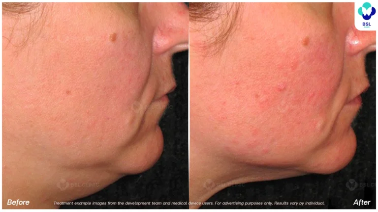 Before After result ultraterapy Chin and Jawline