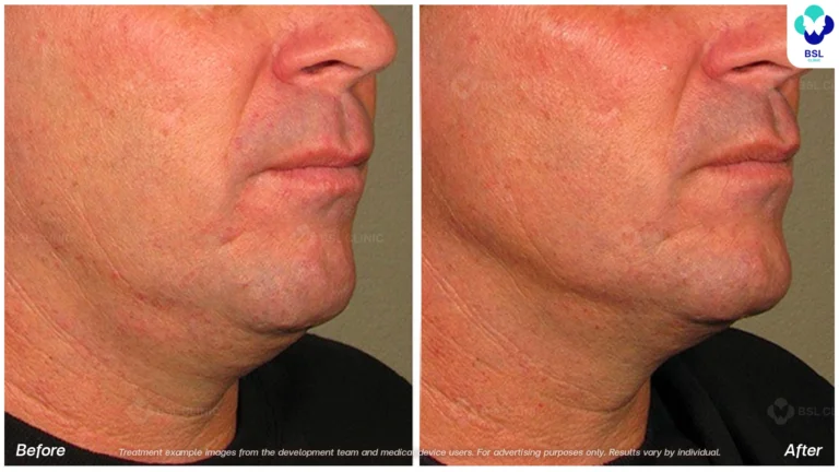 Before After result ultraterapy Chin and Jawline