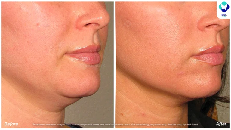 Before After result ultraterapy Chin and Jawline