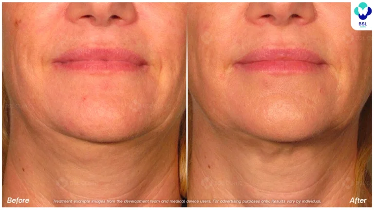 Before After result ultraterapy Chin and Jawline