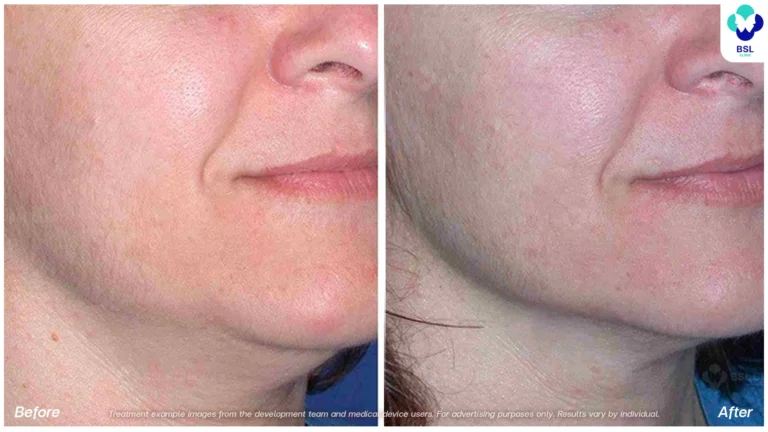 Before After result ultraterapy Chin and Jawline