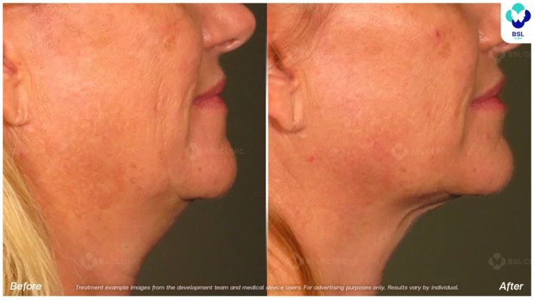 Before After result ultraterapy Chin and Jawline