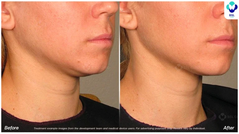 Before After result ultraterapy Chin and Jawline