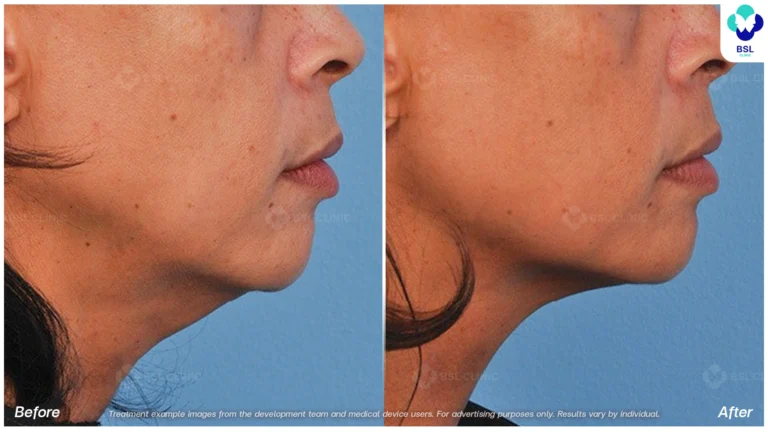 Before After result ultraterapy Chin and Jawline