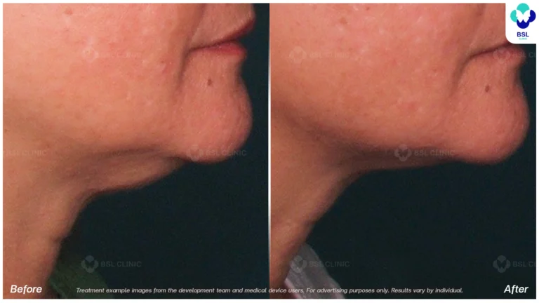 Before After result ultraterapy Chin and Jawline