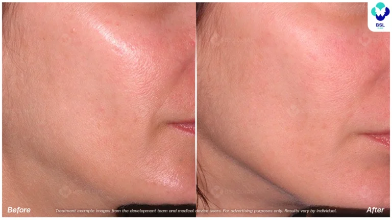 Before After result ultraterapy Chin and Jawline