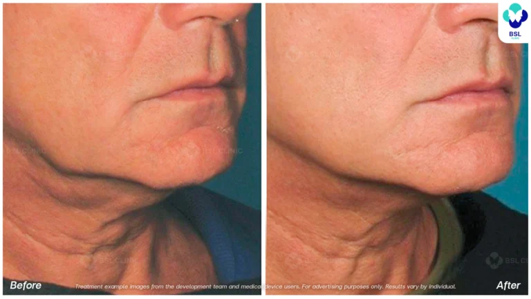 Before After result ultraterapy Eyebrows
