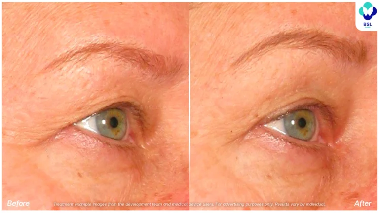 Before After result Ulthera Eyebrows