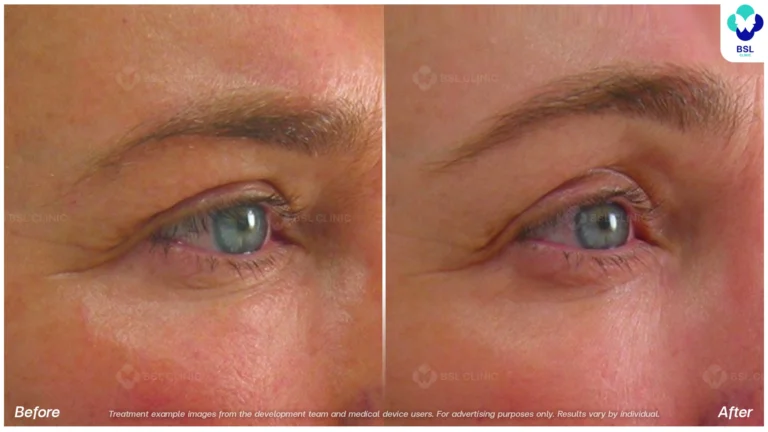 Before After result Ulthera Eyebrows