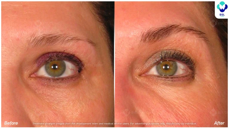 Before After result Ulthera Eyebrows