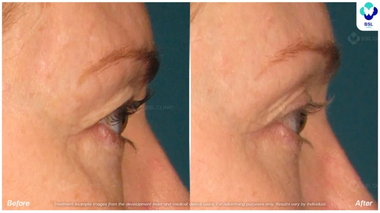 Before After result Ulthera Eyebrows