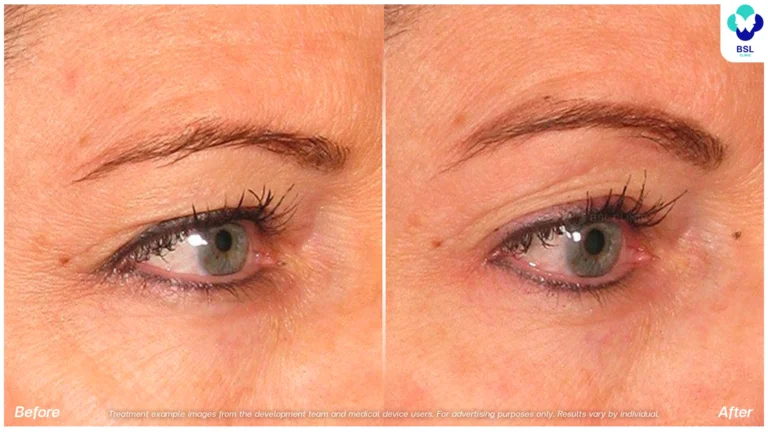 Before After result Ulthera Eyebrows