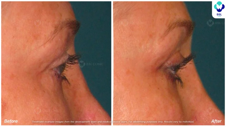 Before After result Ulthera Eyebrows