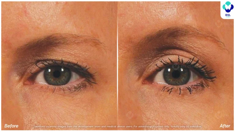 Before After result ultraterapy Eyebrows