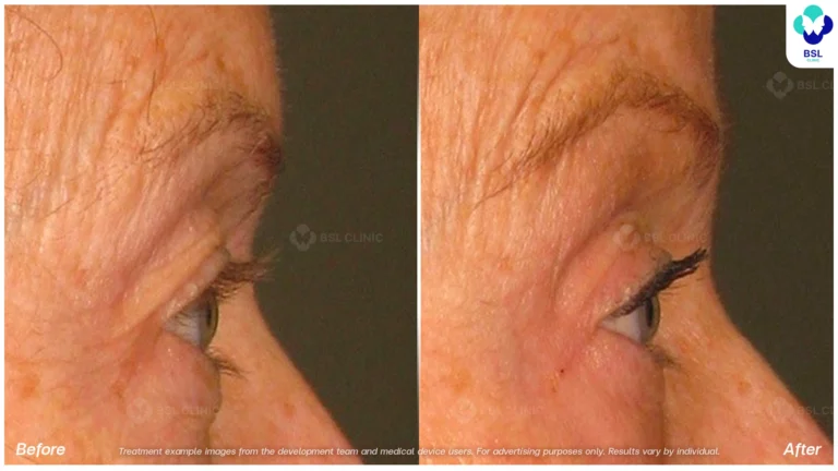 Before After result ultraterapy Eyebrows