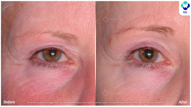 Before After result ultraterapy Eyebrows