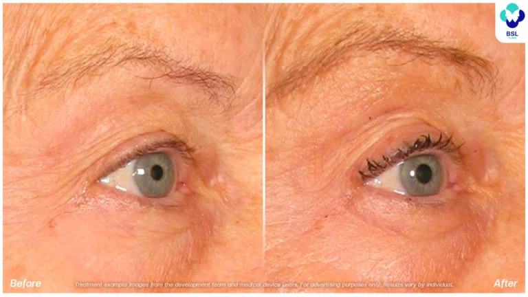 Before After result Ulthera Eyebrows