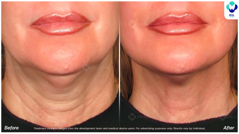Before After result ultraterapy Neck