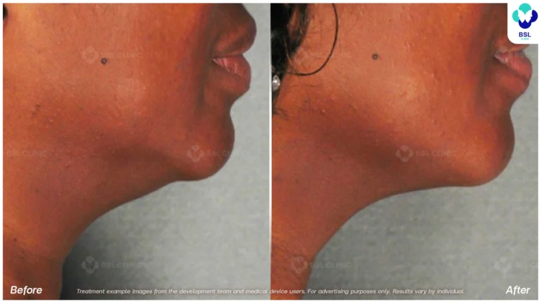 Before After result ultraterapy Neck