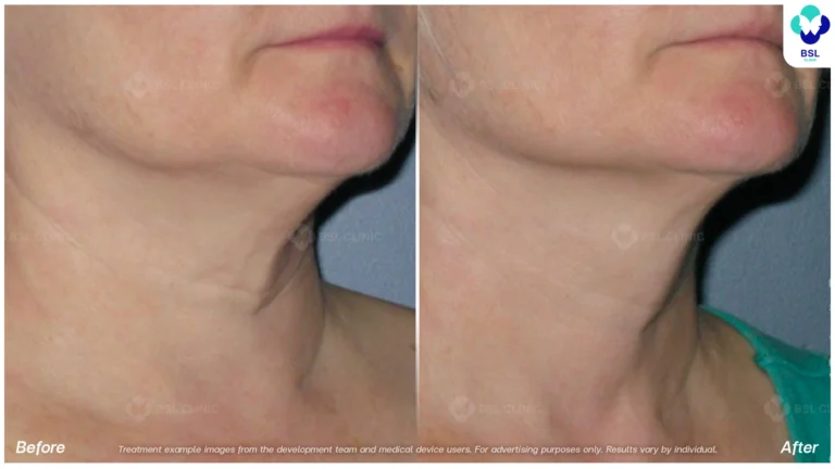 Before After result ultraterapy Neck