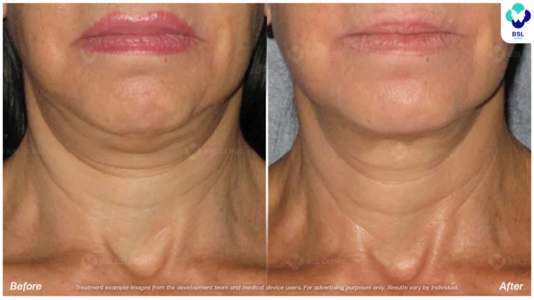 Before After result ulthera Neck
