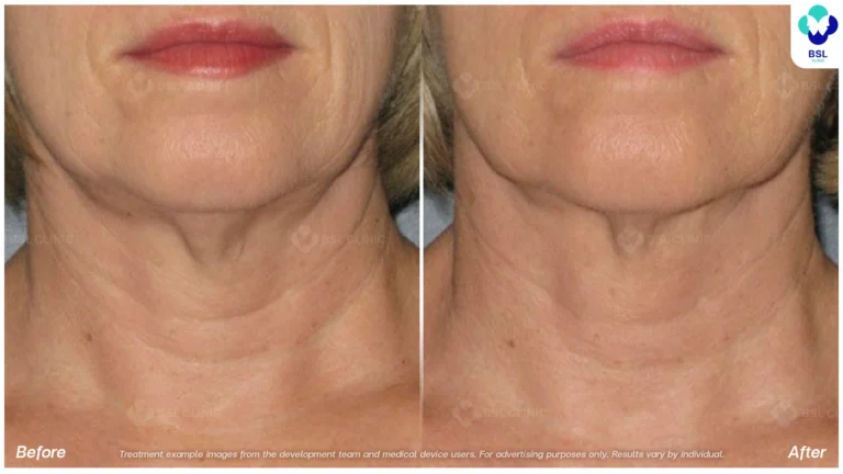 Before After result ulthera Neck