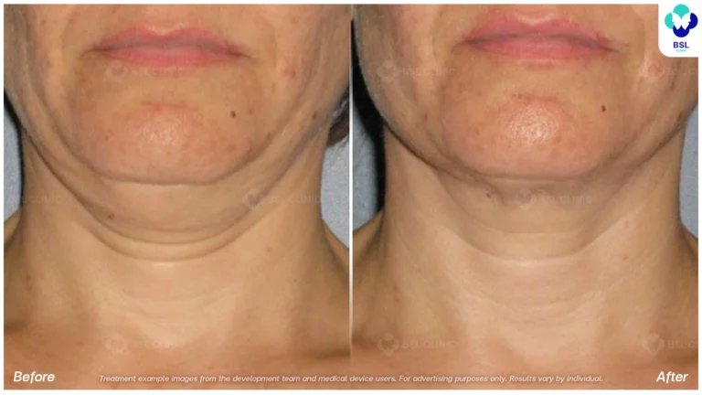 Before After result ulthera Neck