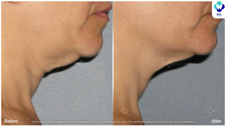 Before After result ulthera Neck