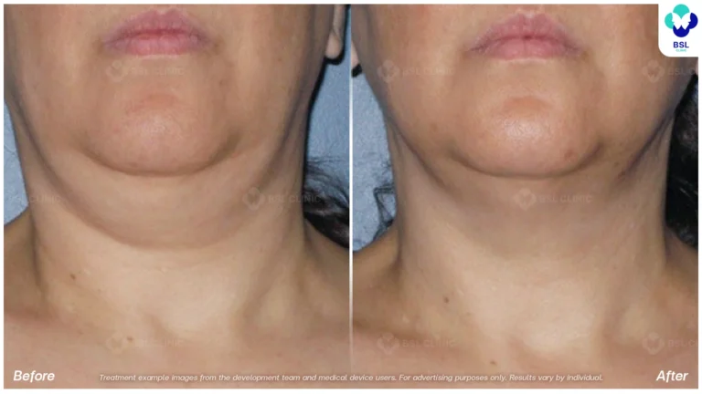 Before After result ulthera Neck