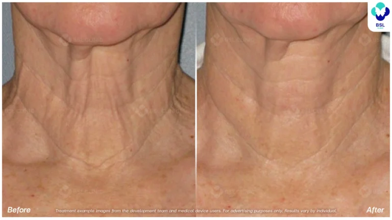 Before After result ulthera Neck
