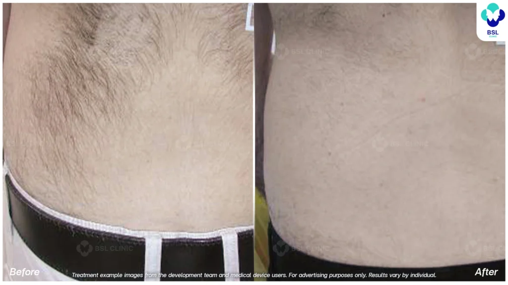 result Hair Removal Treatments