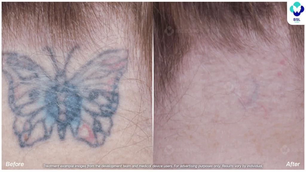 result Tattoo Removal Treatments