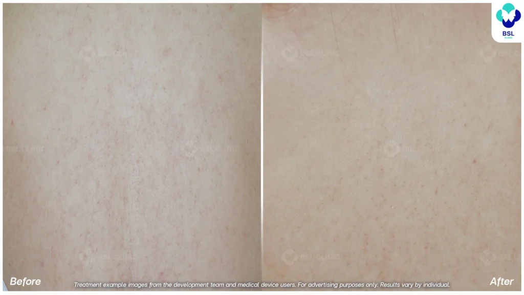 result Keratosis Pilaris Treatments