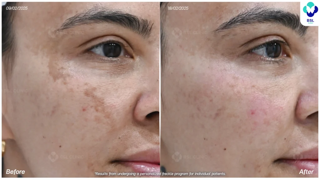 result Melasma Treatments