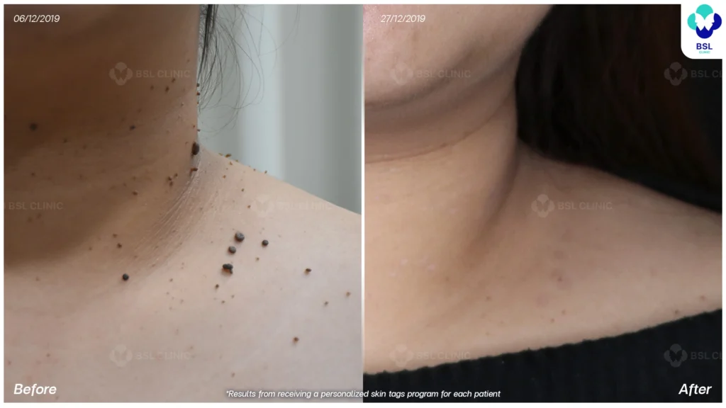 result Mole, Seborrheic Keratosis Treatments