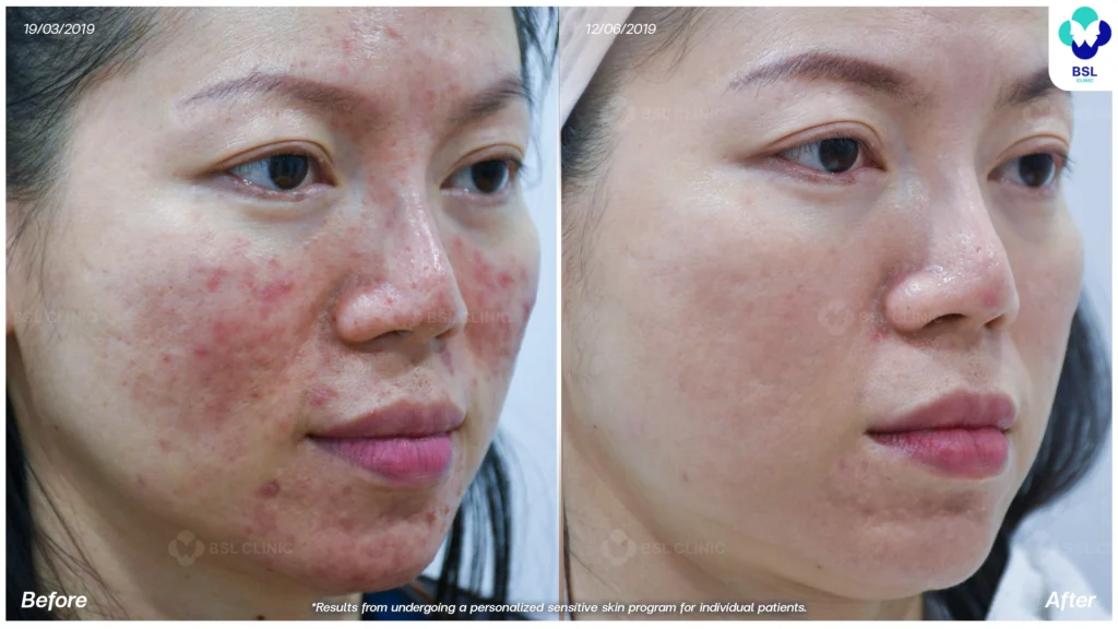 result Sensitive Skin Treatments