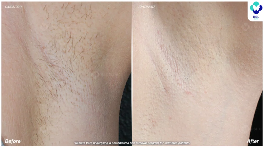 result Underarm Brightening Treatments