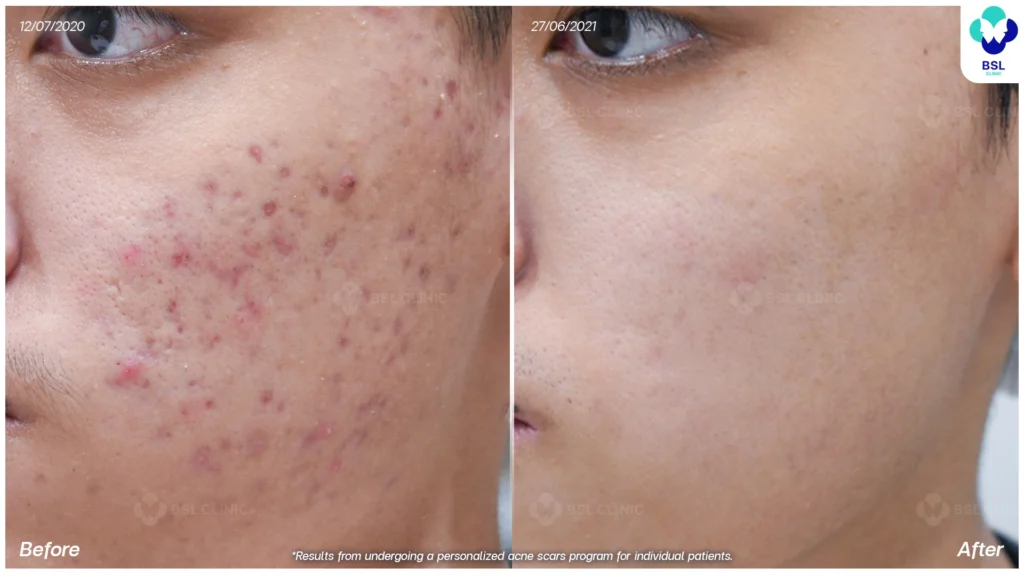 result Laser scar treatments