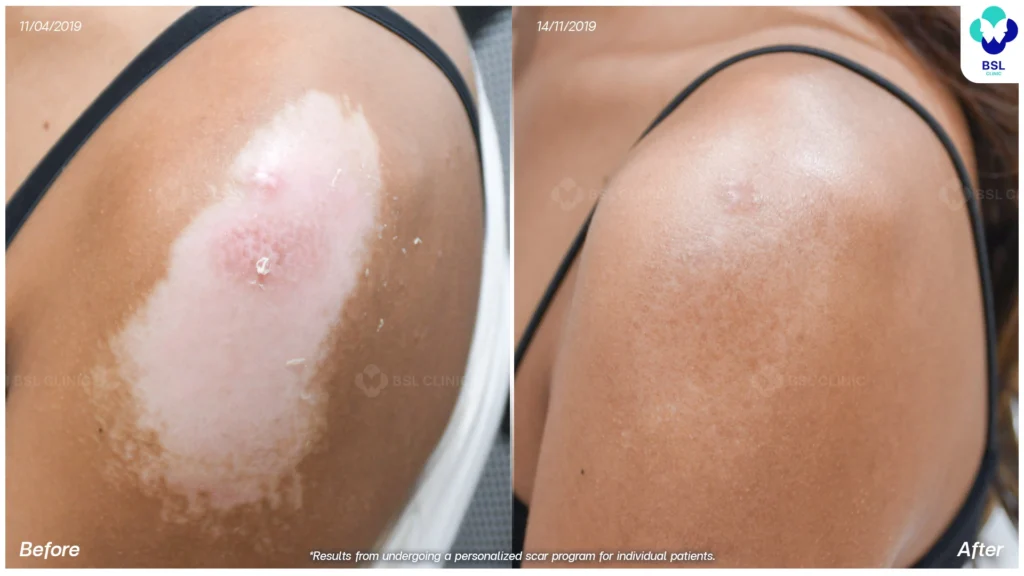 result Laser scar treatments