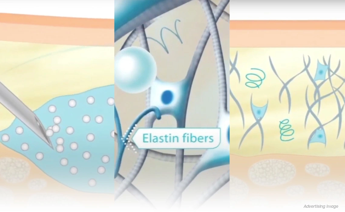 How Does the Radiesse Program Work