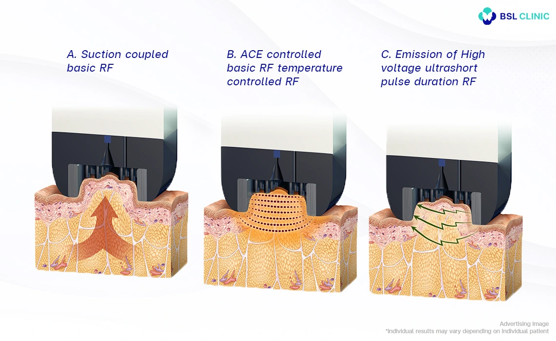 Body contouring BodyFX Program How Does it Work
