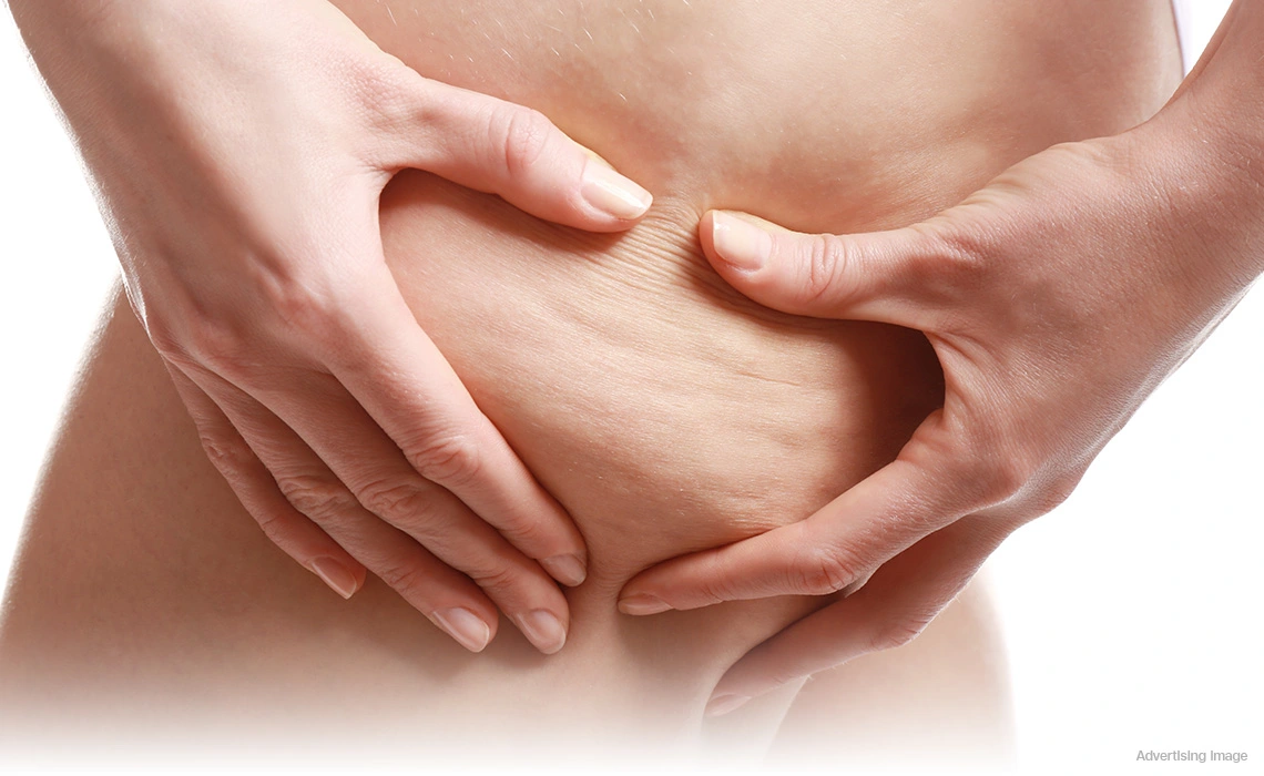 cellulite