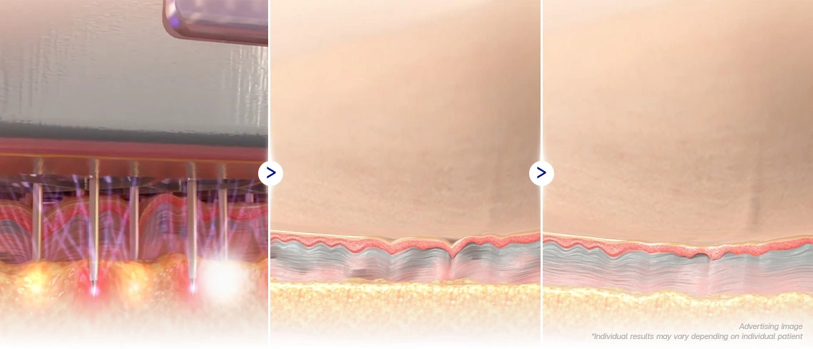 How does the Morpheus8 Body Program work