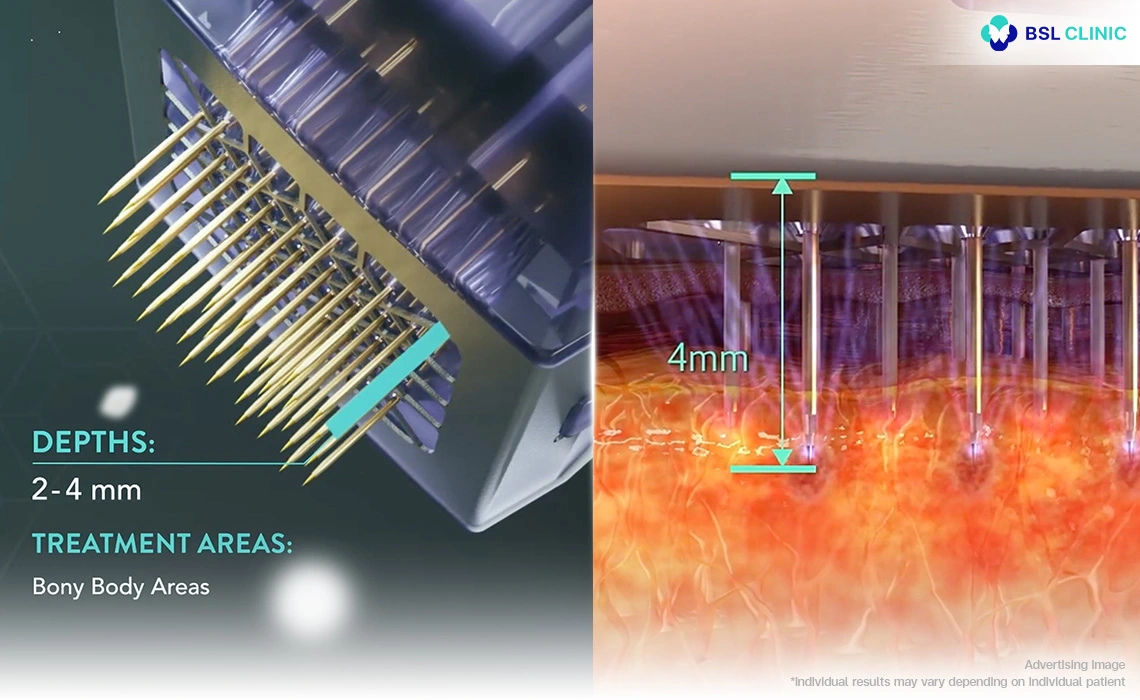 morpheus8-rf-microneedling-depth-illustration-showing-morpheus-and-morpheus8-technology-by-inmode-targeting-multiple-skin-layers-for-cellulite-treatment-and-body-contouring-with-morpheus8-cost-context