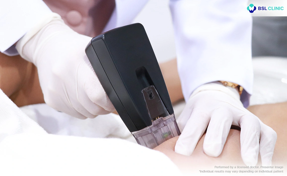 Morpheus8 body care has five distinct benefits