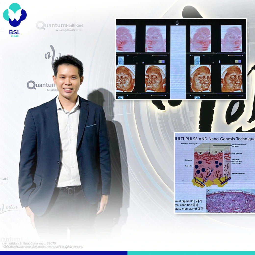 Melasma Program training