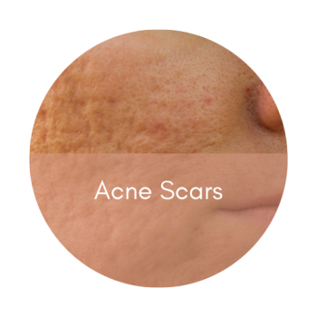 rejuran polynucleotides acne scars post acne skin renewal